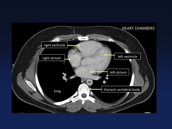 ctisus's tweet photo. Heart chambers

From our MDCT atlas with @PamelaJohnsonMD 

https://t.co/jWgTRtEQnb https://t.co/mBHAR9vbjs
