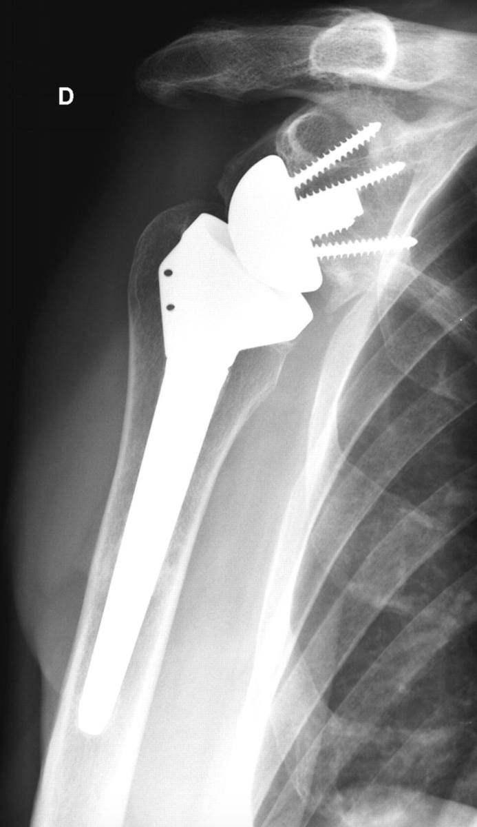 jbjs's tweet photo. Updated #JBJSClinicalSummary on Reverse Shoulder Arthroplasty
By: E. Scott Paxton, MD @escottpaxton #UniversityOrthopedics
@UnivOrtho https://t.co/BsTjTa8ecA