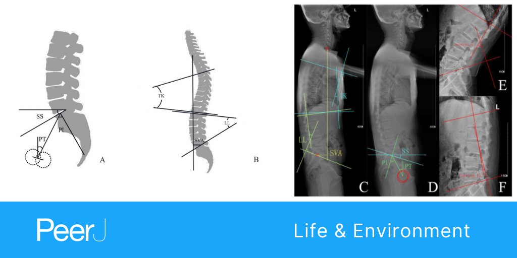 PeerJSTM's tweet photo. Liu et al. examine spinal-pelvic sagittal parameters in patients with gluteal #muscle #contracture - an imaging study 

Read the full article https://t.co/chs0xH1tBT

#Orthopedics #Radiology #MedicalImaging #SportsMedicine https://t.co/zTzko3w9ng