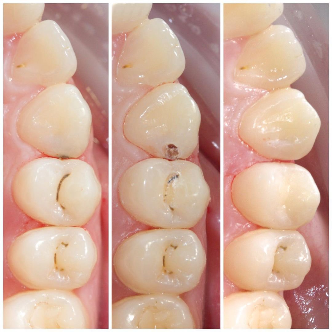 Как оценить качество установки пломбы? 
 
Составили для вас чек-лист, по которому вы сможете легко это проверить. 
 
Переходите по ссылке instagram.com/p/CbAo71xAUw1/…  #стоматологияспб #лечениекариесаспб #стоматологспб