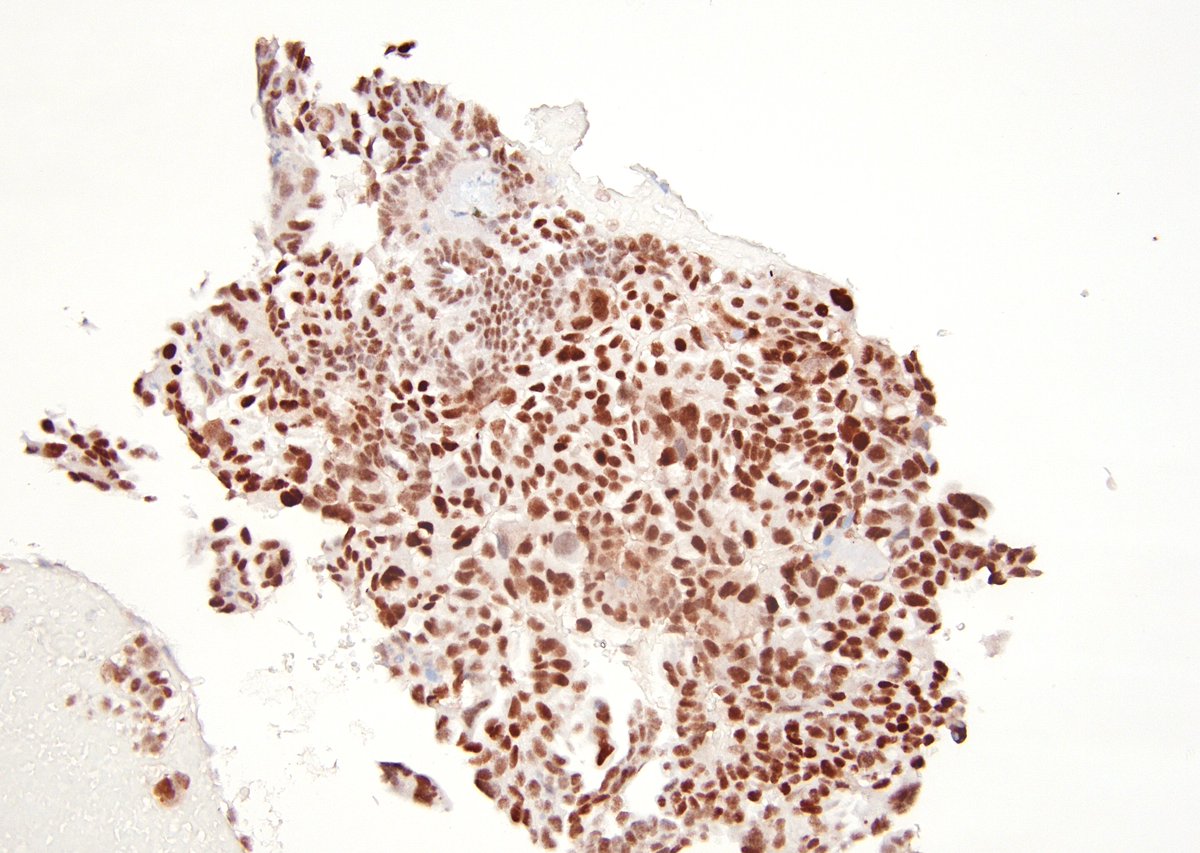 sza_jhcyto's tweet photo. IMPRESSIVE psammoma bodies in an EUS-FNA of a gastric mass. CB and PAX-8 IHC confirmed metastasis from the patient's known ovarian serous carcinoma. https://t.co/rc3ymeDLUj