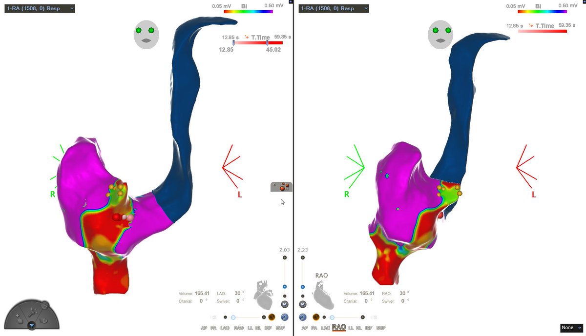 GiacomoMugnai's tweet photo. AVNRT ablation in a 40 yo pt with persistent left superior vena cava (previously unknown). Slow pathway elimination (no more jumps/echos; no inducibility). Zero XRAYs.
#EPeeps #CARTO #AVNRT #PLSVC https://t.co/VmZkeLfTUe