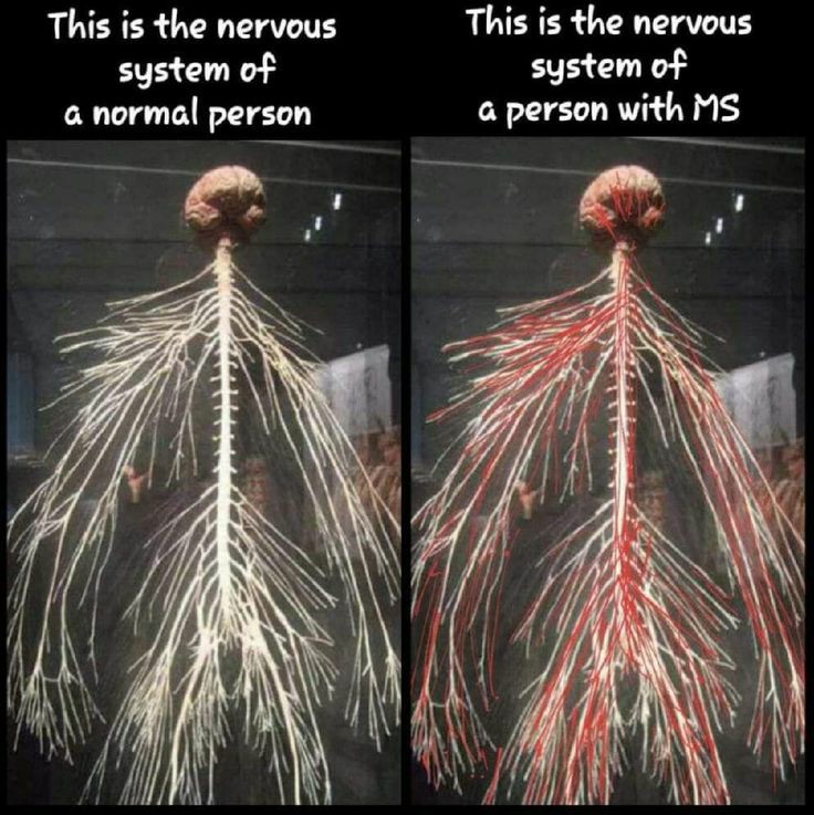 GenaMSwarrior's tweet photo. #NervousSystem of a normal person compared to a nervous system of a person with #MS π
#MSFighter #MSChangedMe #NervePain https://t.co/1npy1nQQAb