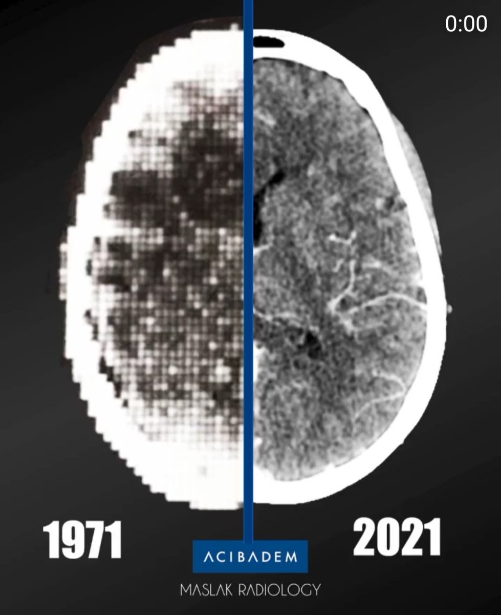 JorgeArellanoAp's tweet photo. Imagen #CT &amp; #TC de un estudio de cráneo 

En el lado derecho la imagen de 1971 y en el lado izquierdo la imagen de 2021 según mira un #TSID la imagen de #Radiología

Si la tecnología avanza tan rápido, también la formación de los #TécnicosRadiología debe avanzar a la Universidad https://t.co/ameFKbotgM