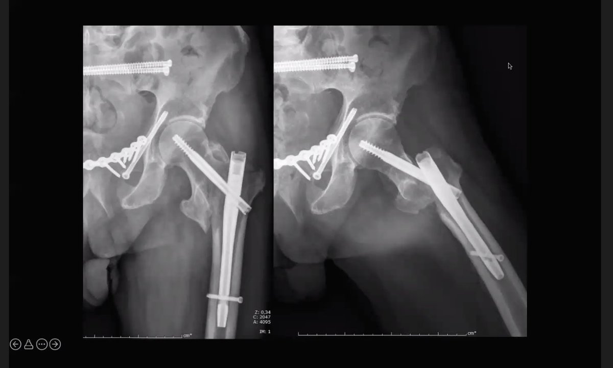 cot_csi's tweet photo. Finalizamos el #Modulo6 y la semana con uno de los autores del libro “Learning from #failures in #Orthopedic #Trauma”, el Dr. M. Videla, de la #UTO @cot_csi, que presenta y razona una colección de casos con el fin de ayudarnos a mejorar como #Traumatologos @doctorvidela @AOSpain https://t.co/OmBgCCdJ3L