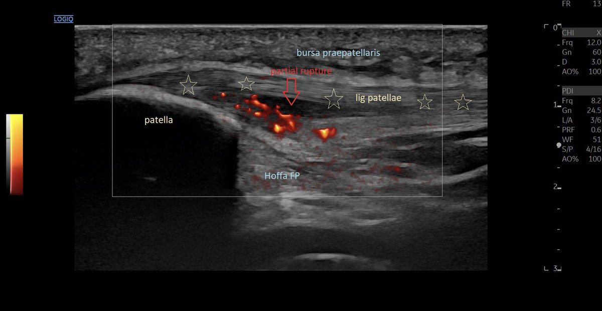 SportklinikBern's tweet photo. #jumpersknee with #partialrupture and #neovascularization —> #ultrasoundguidedinjection #osteniltendo - #mskus #pocus #pocushub #logiqE10 https://t.co/oaDmzREelV