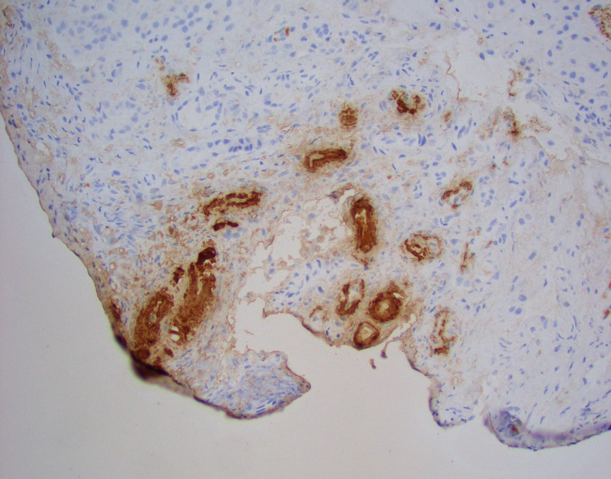 Allograft biopsy for rising serum Cr. At first glance, seemed like vessels had severe hyalinosis c/w chronic CNI tox. But closer looks showed associated giant cells and waxy appearance. Congo red confirmed amyloid. Amyloid A IHC positive. Mass spec pending. #renalpath #kidneypath