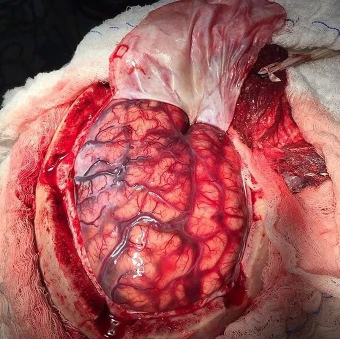 forensicmedic02's tweet photo. Ischemic stroke is the death of a section of brain tissue (cerebral infarction) as a result of insufficient supply of blood and oxygen to the brain due to blockage of the artery.
 The most common causes are: hypertension; smoking; dyslipidemia; diabetes mellitus; alcohol-obesity https://t.co/NHa5b1c9HP