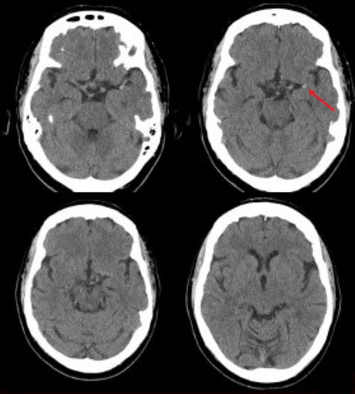 forensicmedic02's tweet photo. Ischemic stroke is the death of a section of brain tissue (cerebral infarction) as a result of insufficient supply of blood and oxygen to the brain due to blockage of the artery.
 The most common causes are: hypertension; smoking; dyslipidemia; diabetes mellitus; alcohol-obesity https://t.co/NHa5b1c9HP