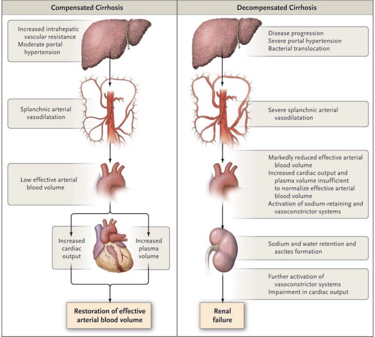 drkeithsiau's tweet photo. Haemodynamic effects in compensated 🆚 decompensated cirrhosis #LiverTwitter #MedEd

(Via @NEJM) https://t.co/JNQnGzNu8c
