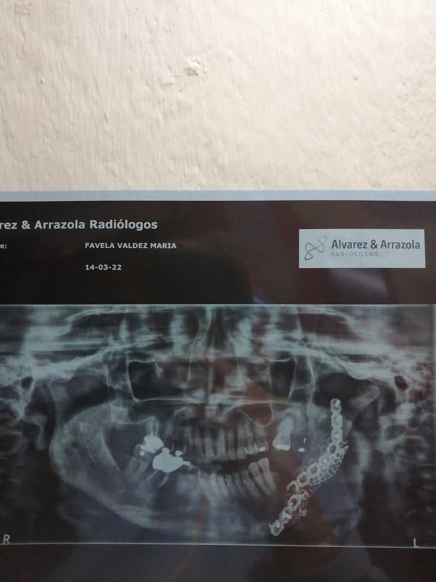 renatafavela's tweet photo. Hace 18 años mi mamá fue victima de un asaltante el cual con un disparo le fracturo la mandíbula, cayó de urgencia en el IMSS, el primer doctor que atendió su caso fue un cirujano plástico, cuando se quiso remitir a maxilo resultó que estos dos doctores eran “enemigos” https://t.co/3bdGGsFVyt