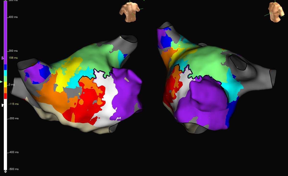EmilyWilliamsEP's tweet photo. Awesome atypical flutter mapped using #OT on #EnsiteX at @MUSCHealthCola @subparsonsmaps @AbbottCardio #EPeeps #OT #onlywithOT #HDGrid #AbbottEP https://t.co/xlQk3xr72q
