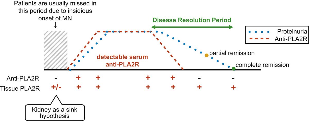 🤩 #PLA2R
Remains superstar against all of the up-and-coming Membranous GN antigens!

Used for:
✅ Diagnosis
✅ Deciding whom to treat
✅ Prognosis
✅ Follow-up
✅ Monitoring for remission
✅ Marker in transplant

#NephJC #NephMadness @vernisartan