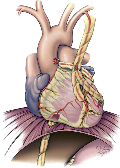 AATSJournals's tweet photo. AATS and STS's reasoning for not endorsing the 2021 ACC/AHA/SCAI Coronary Revascularization Guidelines. Read the joint editorial in JTCVS by Sabik, Guyton, et al: https://t.co/Vn8MS49c6e #JTCVS #CardioTwitter #cvsurg @AATSHQ @tssmn @FaisalBakaeen @MarcMoon_AATS @ChrisMalaisrie https://t.co/Jy4pHQUdWN