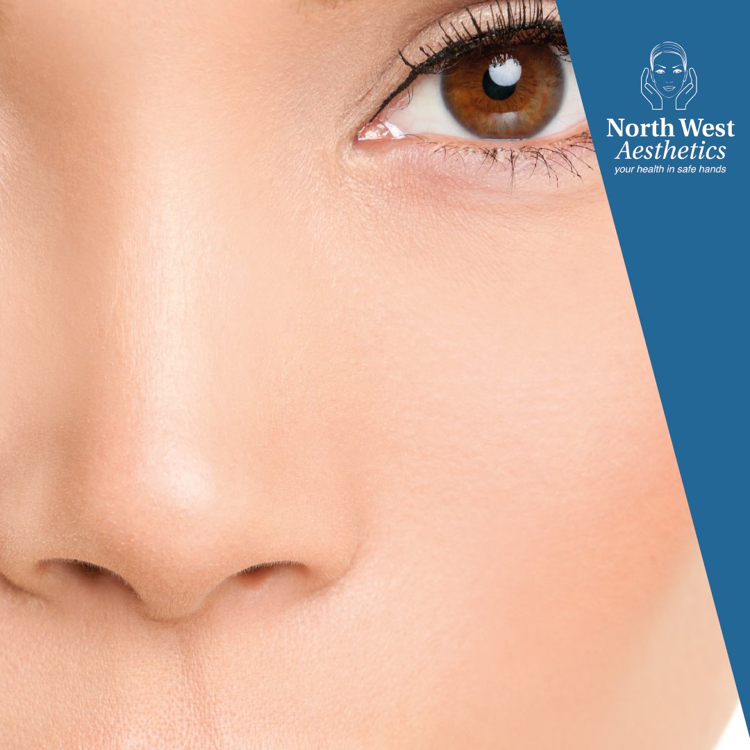 Correct lumps, bumps and hooks with #NonSurgicalRhinoplasty. Adjust the size and shape of your #nose with #DermalFillers from as little as £199. 

Click on the link to find out more: 
northwestaesthetics.co.uk/treatments/der…