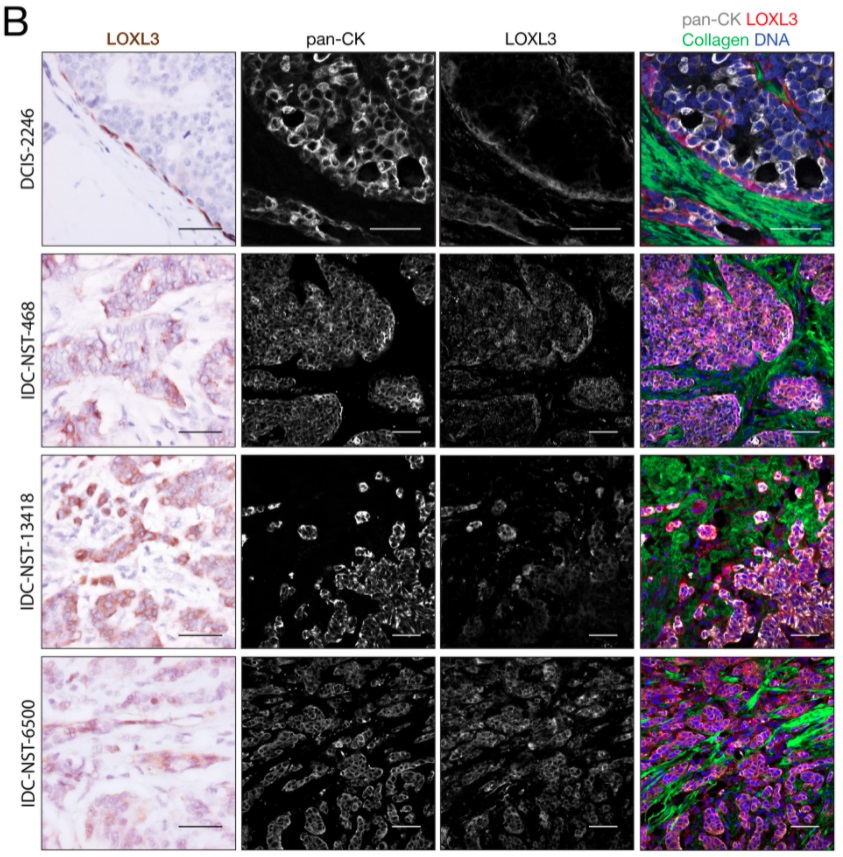 SN_Oncology's tweet photo. Read 'Spatial collagen stiffening promotes collective breast cancer cell invasion by reinforcing extracellular matrix alignment' from @oncogenejournal for free: https://t.co/dgw2POXOKl #Breastcancer #Mechanismsofdisease https://t.co/T81WrKppcT
