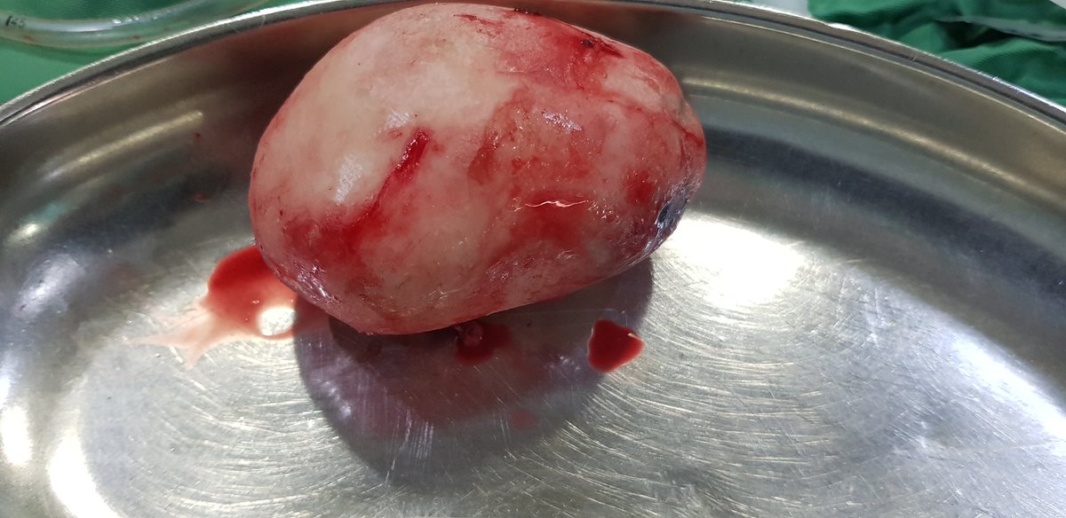 Bagaimana rasanya ada batu sebesar 10 cm di dalam kandung kemih anda ?

Bbrp hari lalu sy melakukan...