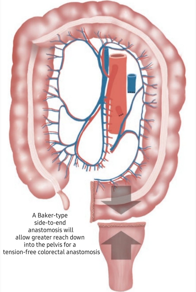 DRAFTABAHMED7's tweet photo. A side-to-end Baker-style colorectal anastomosis. 
𝗥𝗲𝗳:Colorectal Surgery Consultation, Springer, 2019
#MedTwitter #GITwitter 
#Colorectal #pelvic https://t.co/bXe8BEvaMI