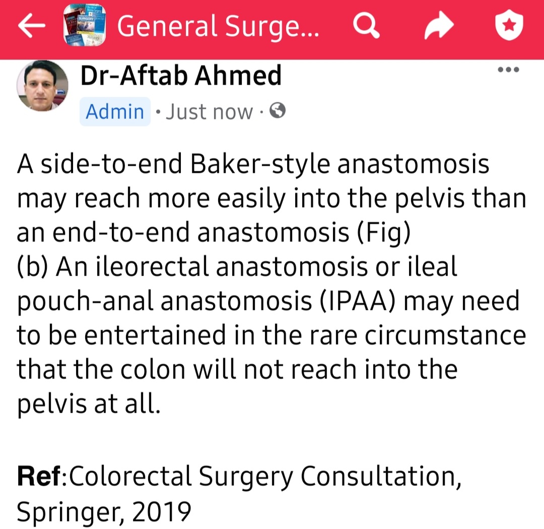 DRAFTABAHMED7's tweet photo. A side-to-end Baker-style colorectal anastomosis. 
𝗥𝗲𝗳:Colorectal Surgery Consultation, Springer, 2019
#MedTwitter #GITwitter 
#Colorectal #pelvic https://t.co/bXe8BEvaMI