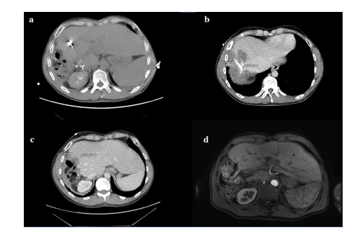 CVIR_Journal's tweet photo. Take a look at this #LettertotheEditor
#Microwave Ablation for Resolution of Persistent #Biloma Following Hepatectomy and Cholecystectomy: Case Report
https://t.co/hsjf0CWT0b https://t.co/MVC8nK5AwS