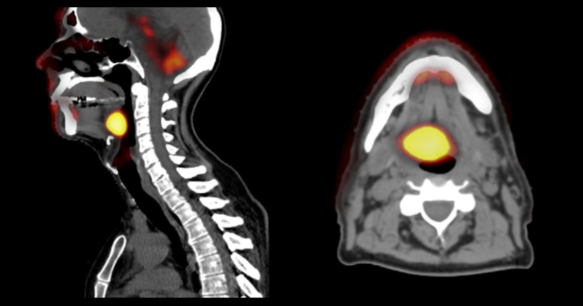 Opscidia's tweet photo. 💥Quand l’IA aide l’oncologue à choisir le meilleur traitement pour son patient💥

💡Le PreSANet, outil développé par l’équipe du Pr Kadoury, prédit des pronostics semblables à ceux réellement vécus par des patients avec un cancer du cou ou de la tête.
(https://t.co/Zi8BDOKlAU) https://t.co/RIqnRULegR
