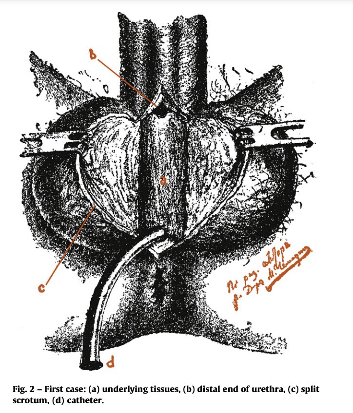 UrologoEdgar's tweet photo. Oral mucosa in reconstructive urethral surgery was first used for urethroplasty in 1894 by experience of Kirill Sapezhko how was born in Chernigov today Ukraine 🇺🇦
#Ukraine https://t.co/FUTR9RFOoa