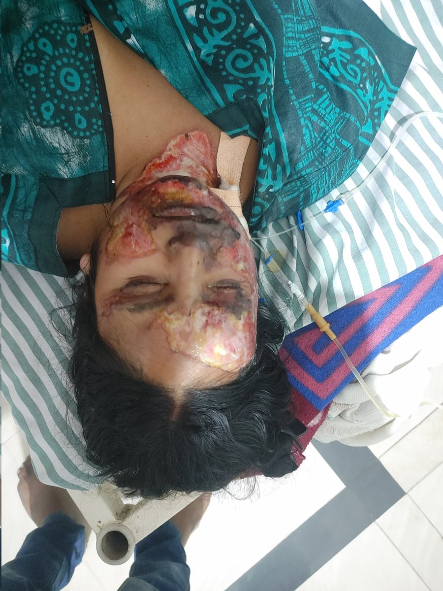 RAJADHISH's tweet photo. My sister has been brutally burnt by her In Law's Family. Have tried to file an FIR but PS- Kanti and Motipur has refused to accept our application. @BJP4Bihar @RSSorg @NCWIndia @bihar_police @CMOBihar1 @ZeeNews @PMOIndia https://t.co/e0KqgOUXGo