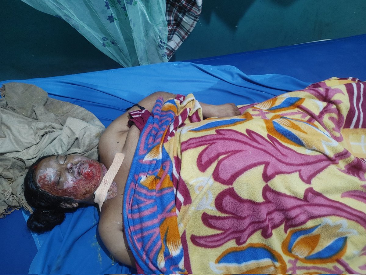 My sister has been brutally burnt by her In Law's Family. Have tried to file an FIR but PS- Kanti and Motipur has refused to accept our application. <a href="/BJP4Bihar/">BJP Bihar</a> <a href="/RSSorg/">RSS</a> <a href="/NCWIndia/">NCW</a> <a href="/bihar_police/">Bihar Police</a> <a href="/CMOBihar1/">Additional District magistrate</a> <a href="/ZeeNews/">Zee News</a> <a href="/PMOIndia/">PMO India</a>