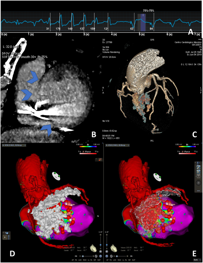In 19 patients with contra-indication for #WhyCMR, late iodine imagine on #YesCCT was 100% accurate at a patient level, 
and 95% accurate at a segment level for the detection of LV fibrosis

ow.ly/gIwU50HZ1Wj