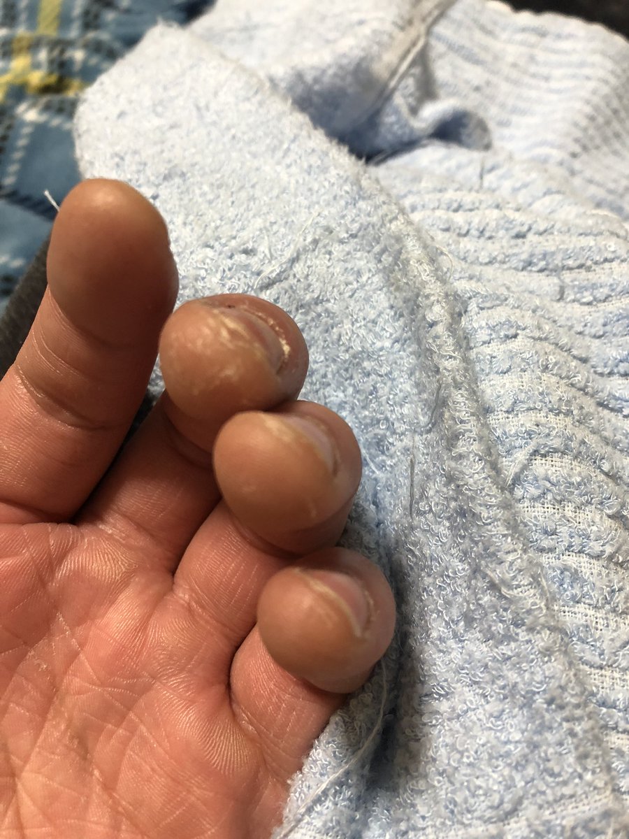 なんであたいの指はこんなにボロボロなんや。
指銃の練習しすぎたかな。
六式ってやっぱり難しいな。。
なぁ。クマドリ（アトラ）