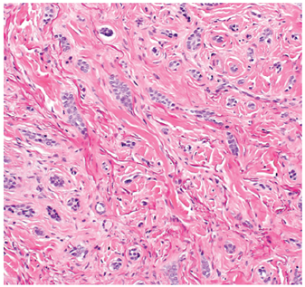 ARP_Press's tweet photo. Ron’s Pics Set #2: Nonmelanocytic Tumors #Skin by Drs. @TBrennster, Goodlad, Mentzel.

Infiltrative basel cell carcinoma (figure 1-94 L, R).

Order book here: https://t.co/tUsLu32DzX. 

#skinpath #dermpath #pathology #tumor #pathresidents https://t.co/iyHq7GtQIg