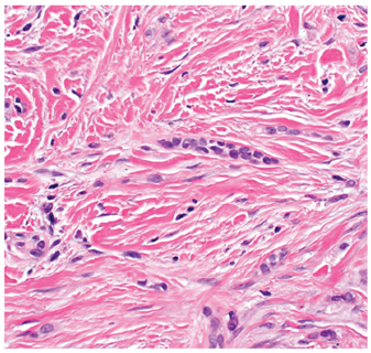 ARP_Press's tweet photo. Ron’s Pics Set #2: Nonmelanocytic Tumors #Skin by Drs. @TBrennster, Goodlad, Mentzel.

Infiltrative basel cell carcinoma (figure 1-94 L, R).

Order book here: https://t.co/tUsLu32DzX. 

#skinpath #dermpath #pathology #tumor #pathresidents https://t.co/iyHq7GtQIg