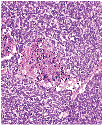 ARP_Press's tweet photo. Ron’s Pics Set #4: Nonmelanocytic Tumors #Skin by Drs. @TBrennster, Goodlad, Mentzel.

Primary cutaneous neuroendocrine (merkel cell) carcinoma (figure 1-112).

Order your copy: https://t.co/tUsLu2L2Ip. 

#skinpath #dermpath #pathology #tumor #pathresidents https://t.co/DRafI7UuPL