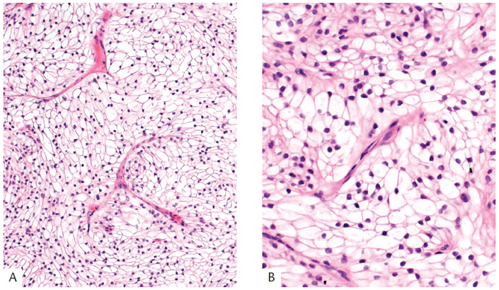 ARP_Press's tweet photo. Ron’s Pics Set #6: Nonmelanocytic Tumors #Skin by Drs. @TBrennster, Goodlad, Mentzel.

Hidradenoma (figure 1-141 A-D).

Order your copy: https://t.co/tUsLu2L2Ip. 

#skinpath #dermpath #pathology #tumor #pathresidents https://t.co/tJd2PZVc4L