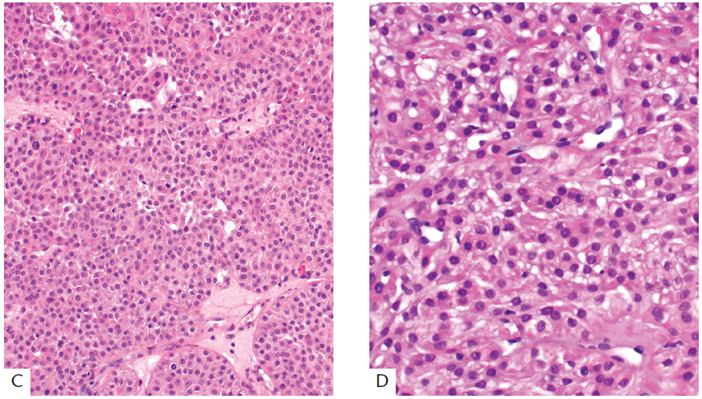 ARP_Press's tweet photo. Ron’s Pics Set #6: Nonmelanocytic Tumors #Skin by Drs. @TBrennster, Goodlad, Mentzel.

Hidradenoma (figure 1-141 A-D).

Order your copy: https://t.co/tUsLu2L2Ip. 

#skinpath #dermpath #pathology #tumor #pathresidents https://t.co/tJd2PZVc4L
