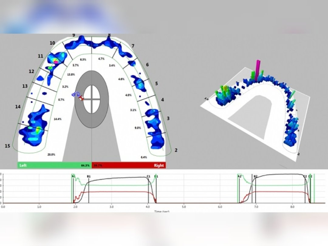 When it comes to diagnosing TMD, the T-scan is an amazing tool to have. It is a sensor that provides dynamic occlusal (bite) measurement, revealing the level, timing, and percentage of force on individual teeth. With this, we can begin to establish a healthy bite.

#dentist