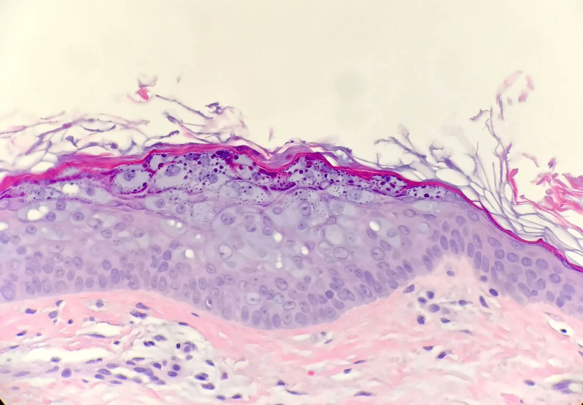 JMGardnerMD's tweet photo. One classic pic. Your diagnosis? Answer &amp; more images:  https://t.co/0PcrTySyNo. Video: https://t.co/R4wVxQ2B26. #pathology #pathologists #pathTwitter #dermpath #dermatology #dermatologia #dermtwitter https://t.co/tVdu2YHkrG