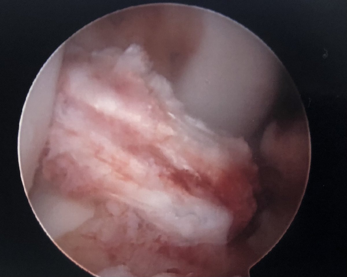 NuelleSportsMD's tweet photo. ACL Friday!
A variety of landmarks can be used to locate the appropriate location at the tibial footprint for an ACL reconstruction. The anterior horn of the lateral meniscus, tibial spine(s) &amp; the native remnant ligament itself can all be used. #orthotwitter https://t.co/ty0OtwhHVF