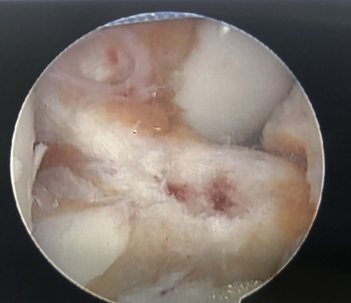 NuelleSportsMD's tweet photo. ACL Friday!
A variety of landmarks can be used to locate the appropriate location at the tibial footprint for an ACL reconstruction. The anterior horn of the lateral meniscus, tibial spine(s) &amp; the native remnant ligament itself can all be used. #orthotwitter https://t.co/ty0OtwhHVF