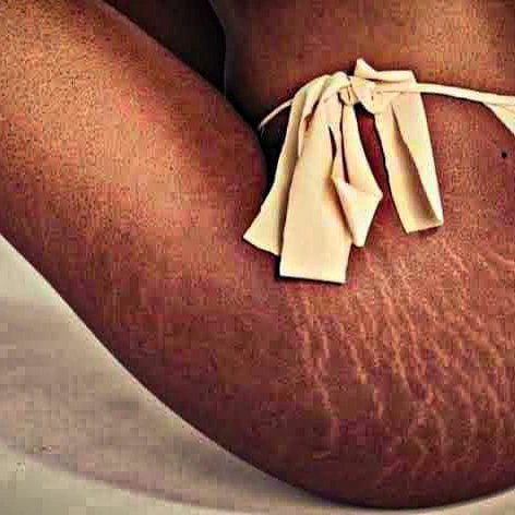 DateSquare2's tweet photo. Guys Is this a sign of beauty or a turn off for you 
Ladies what exposition do you have about stretch marks....

#datesquare #relationship #relationshipgoals #stretchmarks #americangirls https://t.co/fyYpvtUJt7