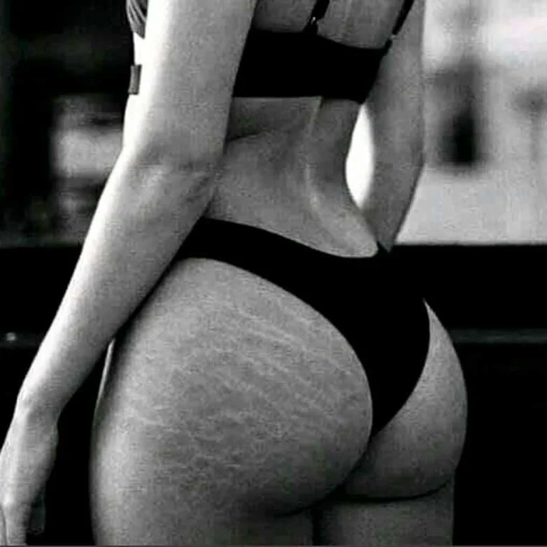 DateSquare2's tweet photo. Guys Is this a sign of beauty or a turn off for you 
Ladies what exposition do you have about stretch marks....

#datesquare #relationship #relationshipgoals #stretchmarks #americangirls https://t.co/fyYpvtUJt7