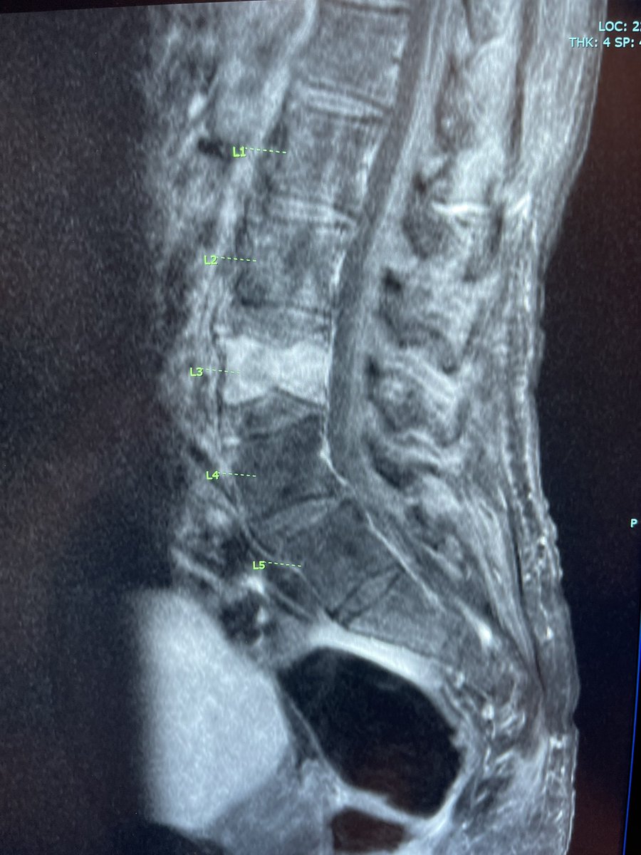 RaDPhung's tweet photo. Awesome ablation and kyphoplasty of a pathologic compression fracture with the expert @JAcharya4  @J2theAO @USCneurorads https://t.co/ug2h5TUbxg