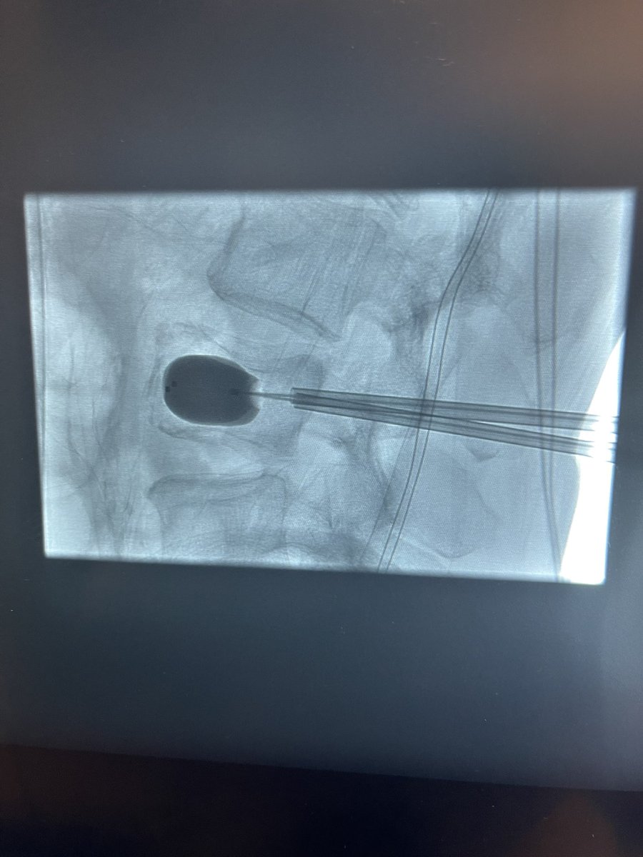RaDPhung's tweet photo. By the book balloon deployment and cement fill @JAcharya4 @J2theAO @USCneurorads https://t.co/CVyF05SBmW