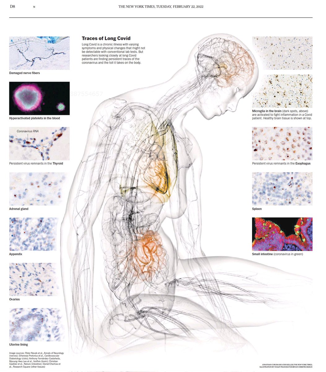 DurianLiftOff's tweet photo. Where to expect traces of the coronavirus in your body after a mild/severe infection:
โข Brain
โข Oesophagus
โข Spleen
โข Small intestine
โข Uterine lining
โข Ovaries
โข Testes
โข Appendix
โข Adrenal gland
โข Thyroid
โข Blood
#LongCovid #MasksSaveLives #MaskUp #FarFromNormal https://t.co/SJbOf9SMuh
