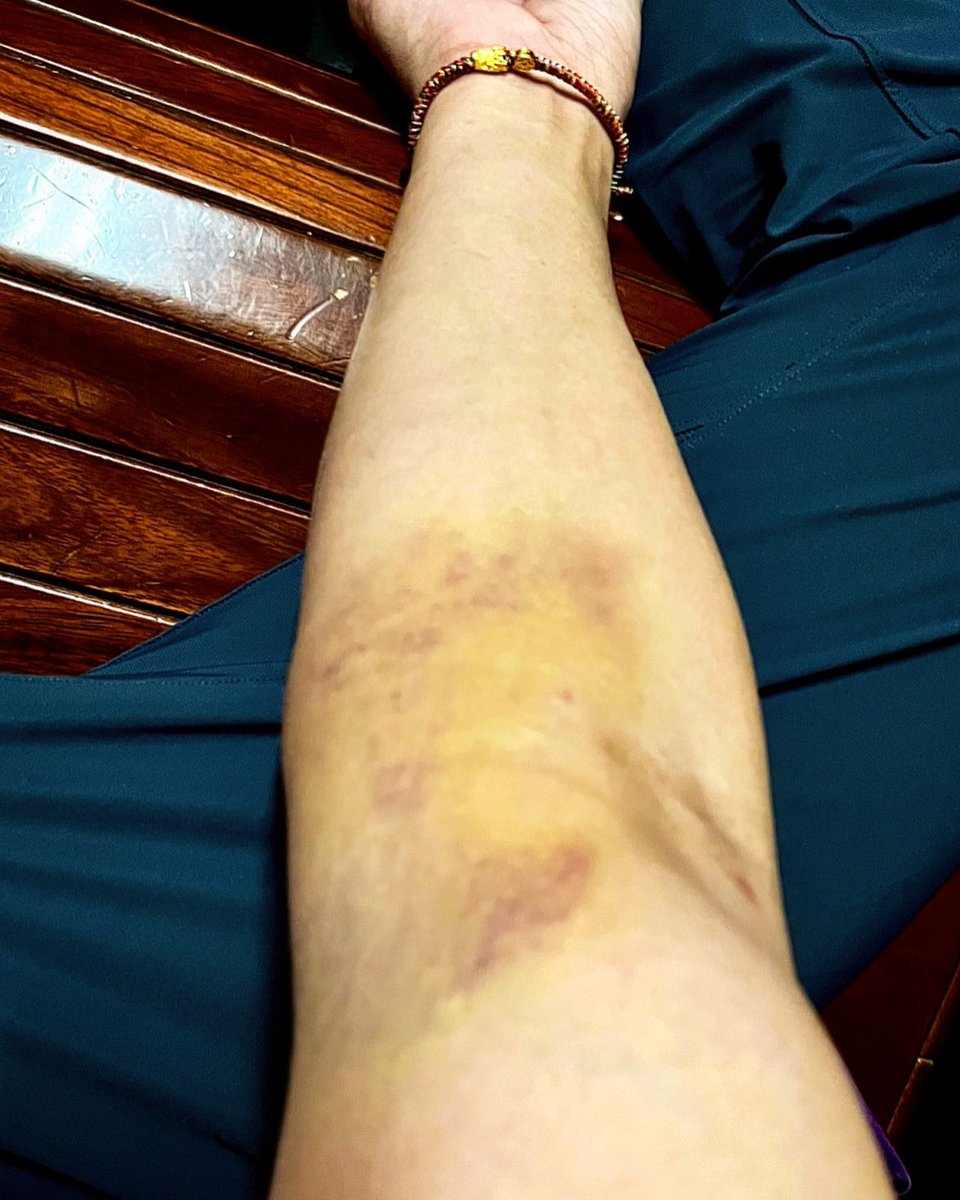 罹癌生病
每週都要打藥穩定血球指數
願每個人的善良能再同理中感受並
做到同理心換位思考
沒人天生喜歡孤獨或是病痛
我們都渴望被理解
因為我有多少個千百個不願意
不是你們口中如此灑脫簡單
過多的是非造謠我也是笑笑带過
答案交給時間證明
但願三月一切順利下莊
沒什麼生日願望
能不動刀是我最大心願