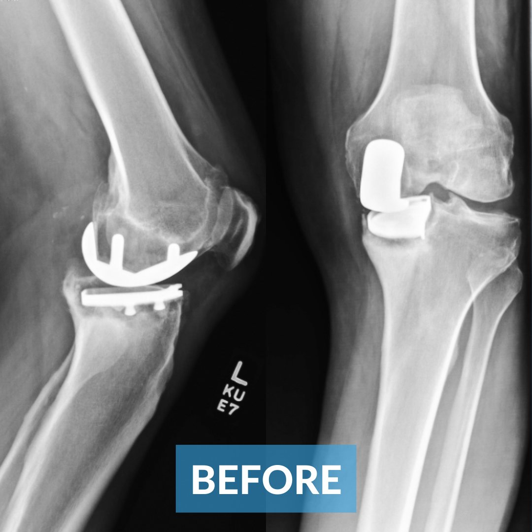 OMGTampaBay's tweet photo. ⬇️ ⬇️ Excellent work this week from @drgoldsmith  ⬇️ ⬇️

Patient had undergone partial knee replacements by another surgeon and one unfortunately failed. He performed a revision surgery, removing the failed components and converting to a total knee replacement. #orthotwitter https://t.co/cidbhA9Usl