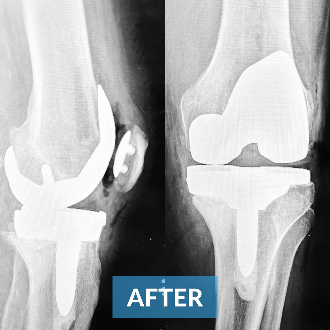 OMGTampaBay's tweet photo. ⬇️ ⬇️ Excellent work this week from @drgoldsmith  ⬇️ ⬇️

Patient had undergone partial knee replacements by another surgeon and one unfortunately failed. He performed a revision surgery, removing the failed components and converting to a total knee replacement. #orthotwitter https://t.co/cidbhA9Usl