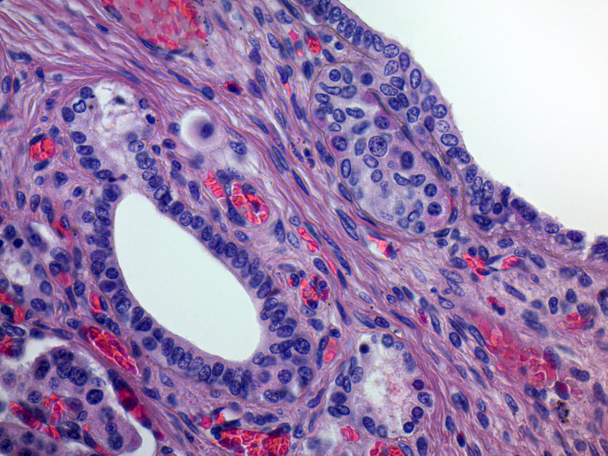 Nesidioblastosis: Persistence of groups of islet cells budging off ducts. A normal finding in neonates /infants. By itself is no longer considered the histologic explanation for congenital hyperinsulinism, as CHI is a functional defect #Pancreas #Pathology #PediPath