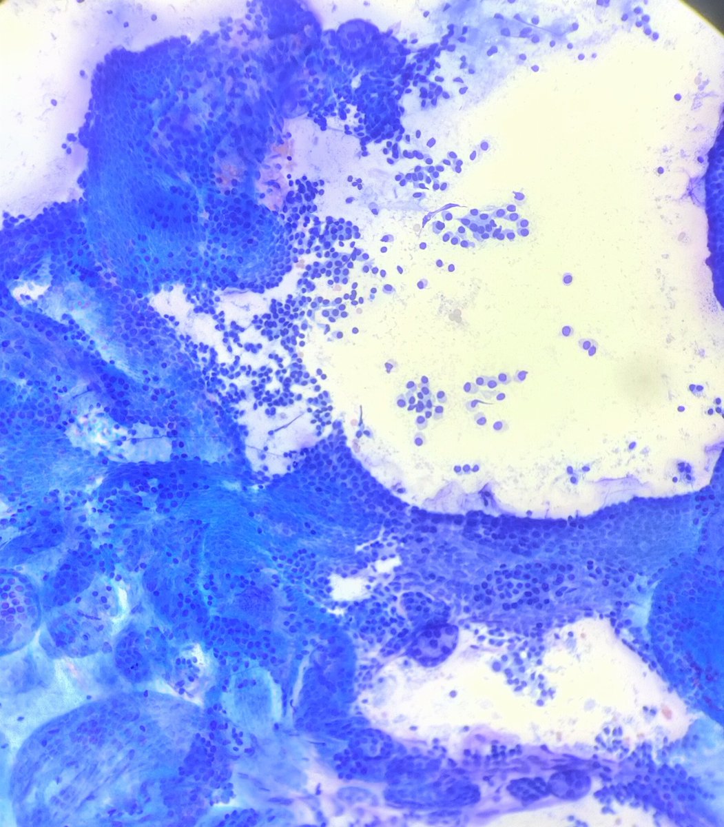 Quique_rs's tweet image. Female, 33 yo. Right thyroid lobe lump. #cytopath #fnapath