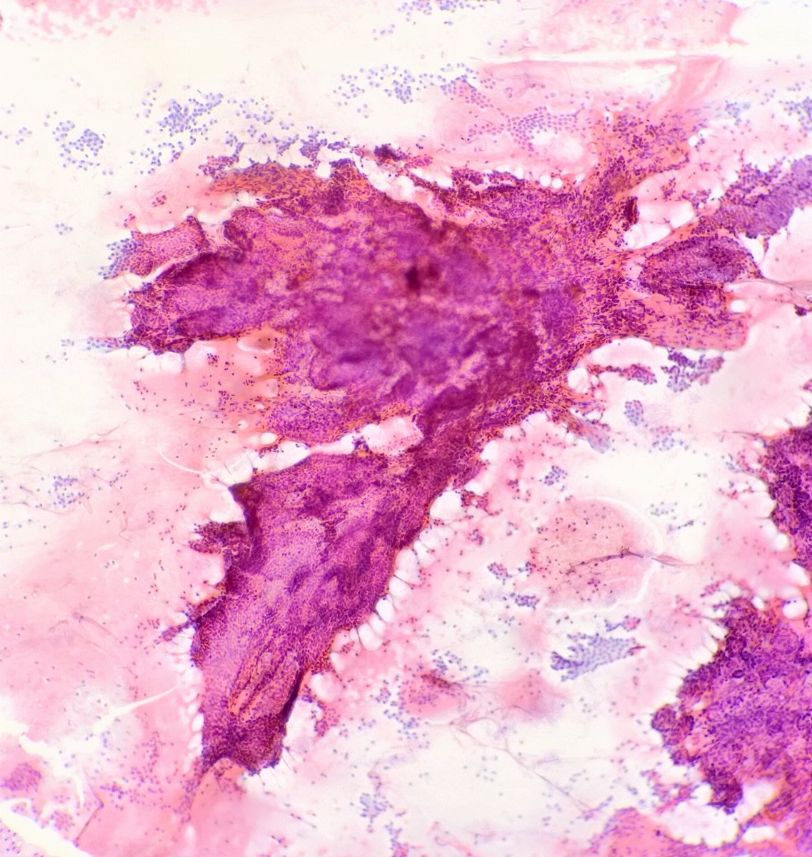 Quique_rs's tweet image. Female, 33 yo. Right thyroid lobe lump. #cytopath #fnapath